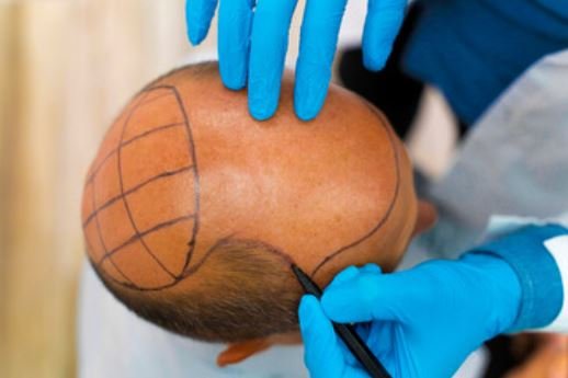 Procedure and Cost of Hair Transplant in Mysore