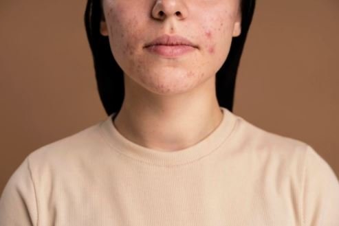What options do I have for treating deep acne scars?