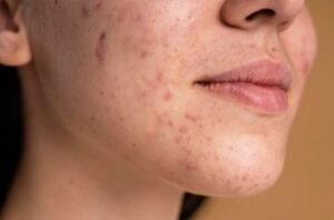 how to get rid of deep acne scars