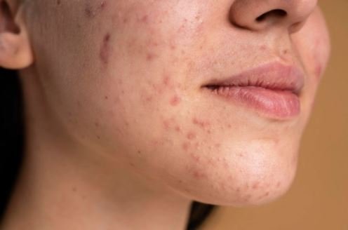 According to Dr. Archit Aggarwal, here’s how to get rid of *deep* acne scars