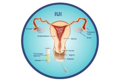 What Is Intrauterine Insemination (IUI)